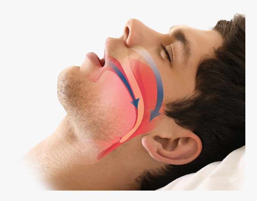 Treatment for Obstructive Sleep Apnea