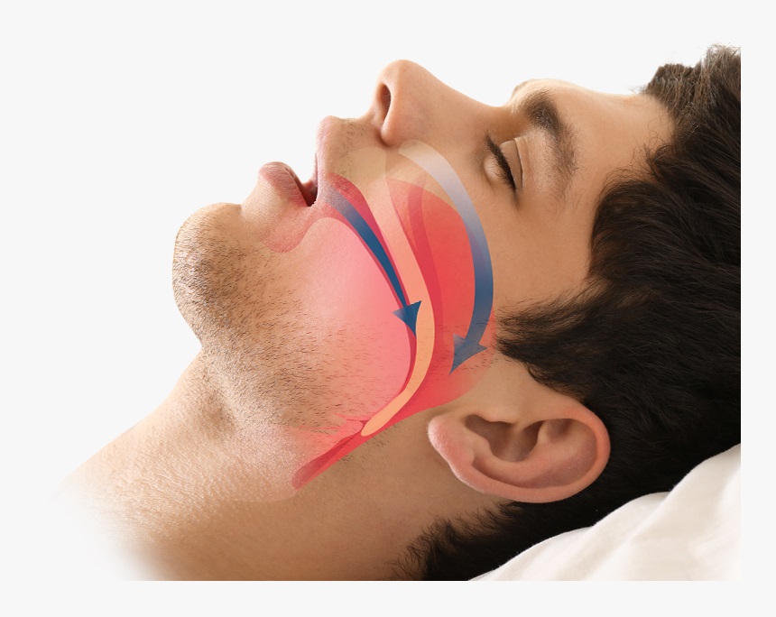 Obstructive Sleep Apnea Chronic Or Acute