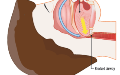 Snoring: Causes and Solutions