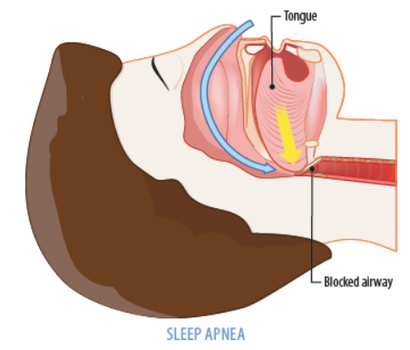 Snoring: Causes and Solutions
