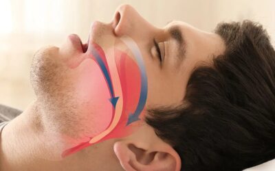 Understanding and Treating Sleep Apnea in Coquitlam, Canada