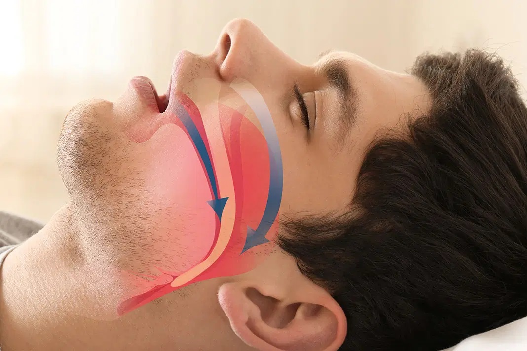 Understanding and Treating Sleep Apnea in Coquitlam