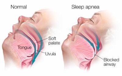 Unveiling Sleep Apnea Symptoms: Recognizing the Signs for Timely Intervention