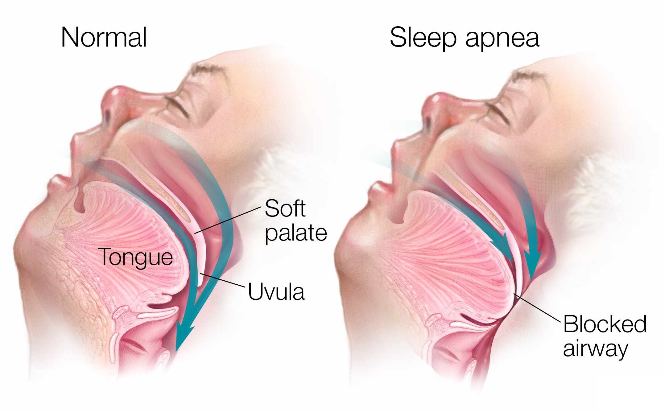 Unveiling Sleep Apnea Symptoms: Recognizing the Signs for Timely Intervention