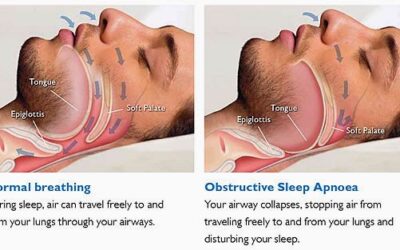 OSA: Understanding Obstructive Sleep Apnea and Treatment Options