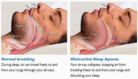 OSA: Understanding Obstructive Sleep Apnea and Treatment Options