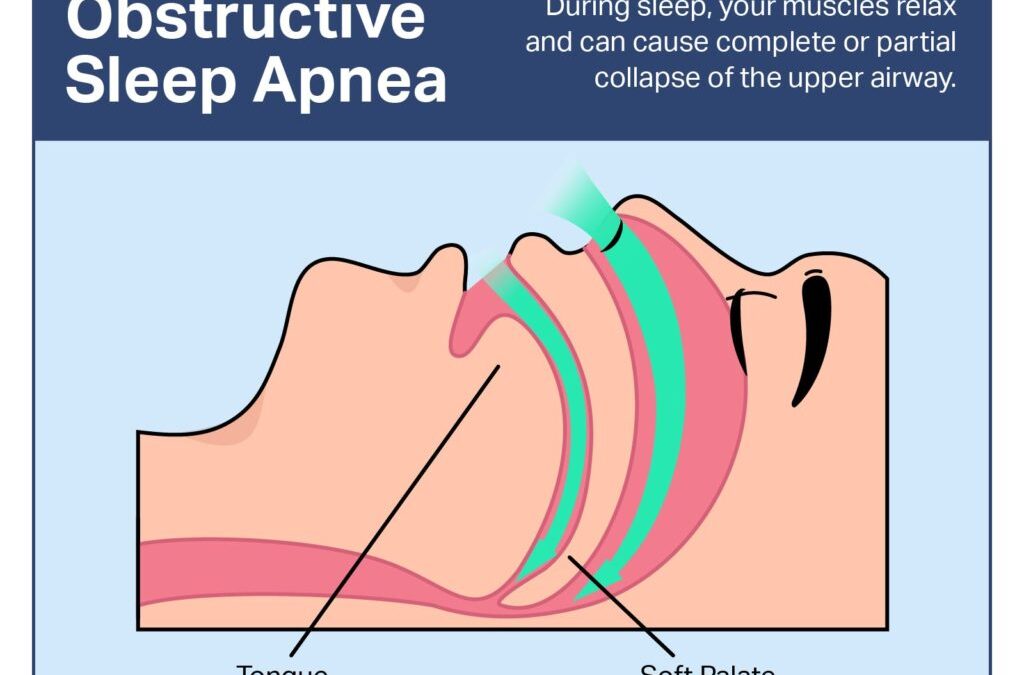 OSA Diagnosis: Understanding and Managing Sleep Apnea