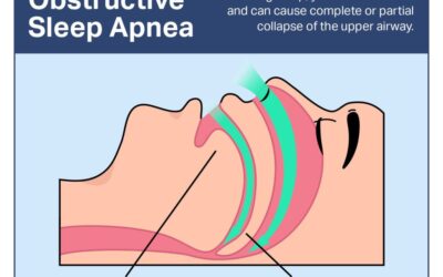 OSA Diagnosis: Understanding and Managing Sleep Apnea