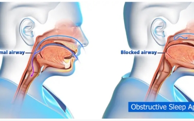 OSA Diagnosis: Understanding Obstructive Sleep Apnea and Its Impact