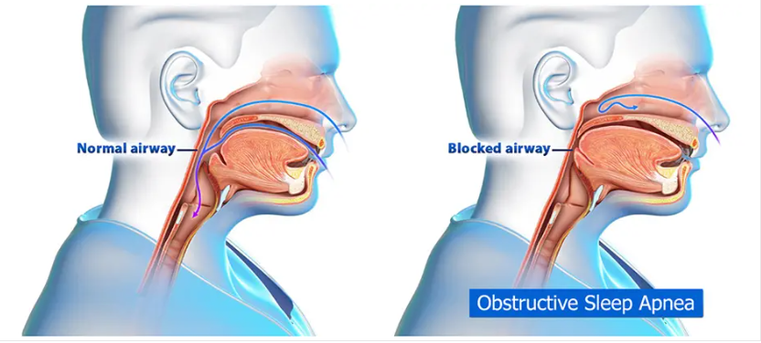 OSA Diagnosis: Understanding Obstructive Sleep Apnea and Its Impact