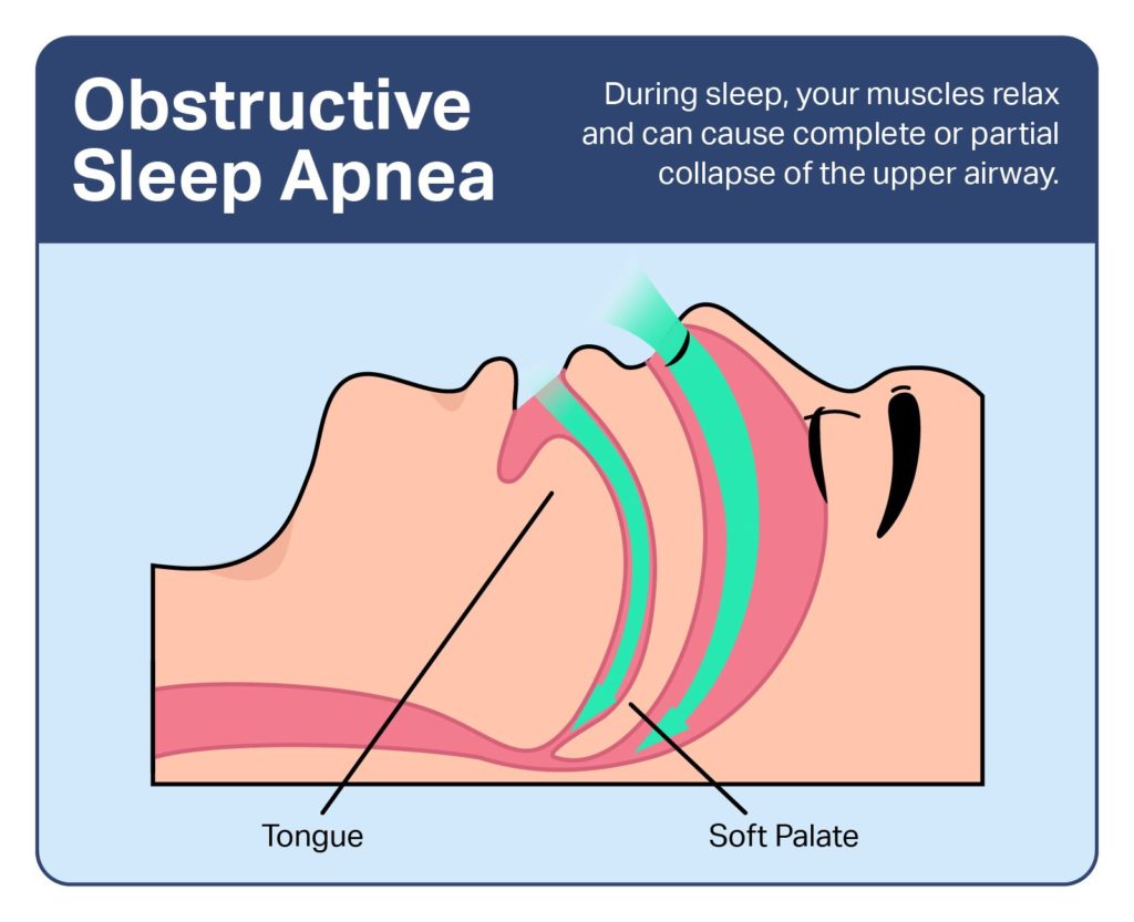 OSA Diagnosis: Understanding and Managing Sleep Apnea - CPAP